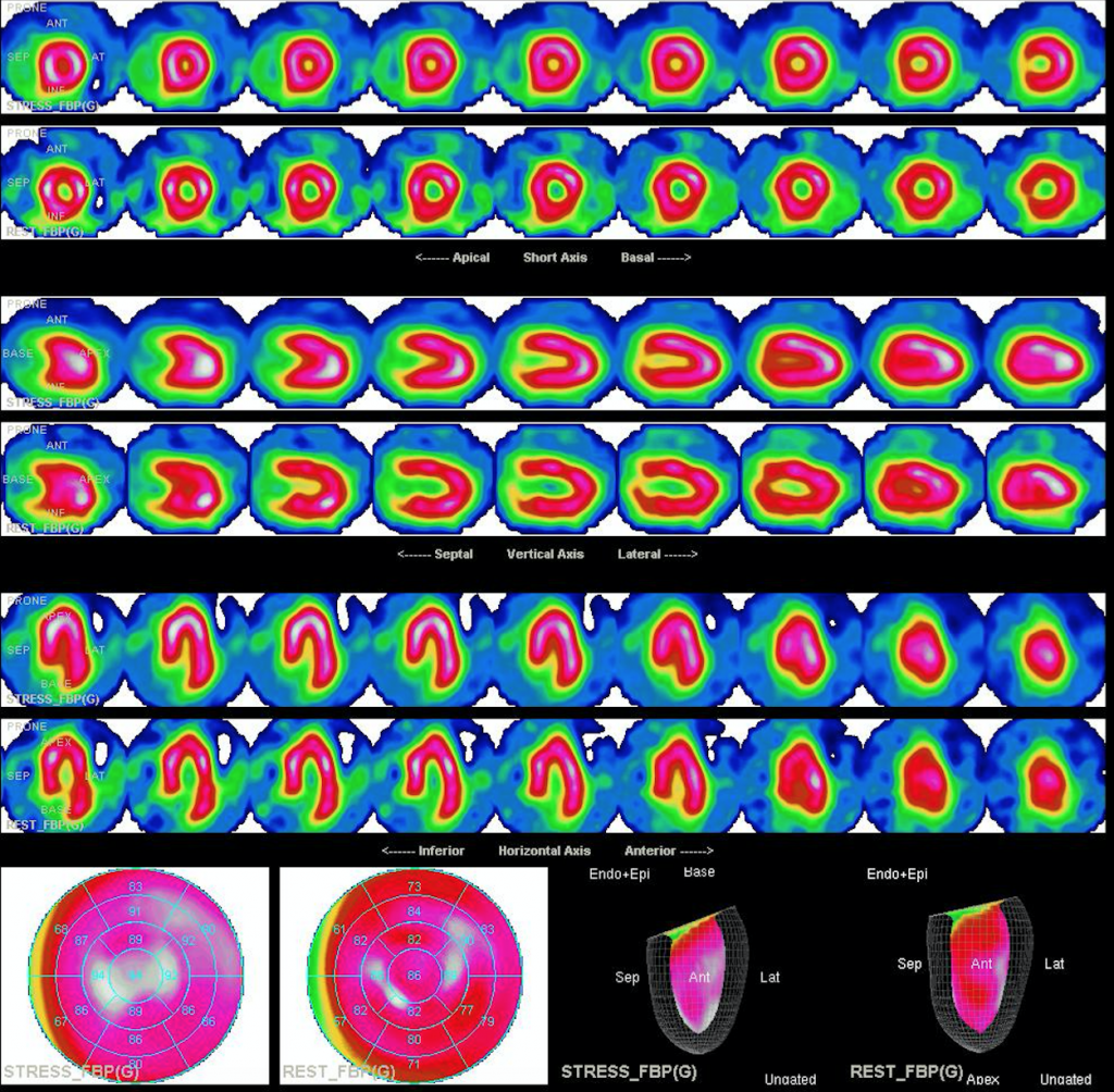 Scintigraphie Myocardique